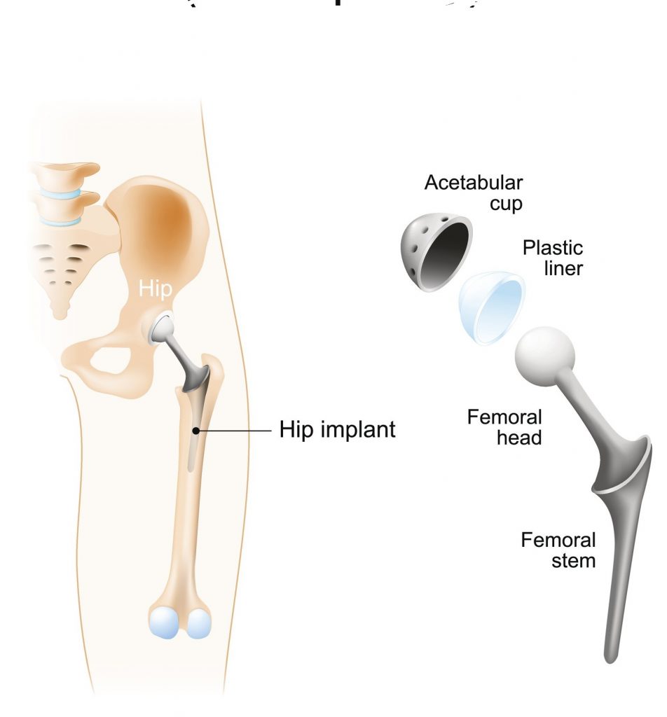 Joint Replacement