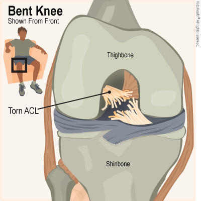 ACL Injury