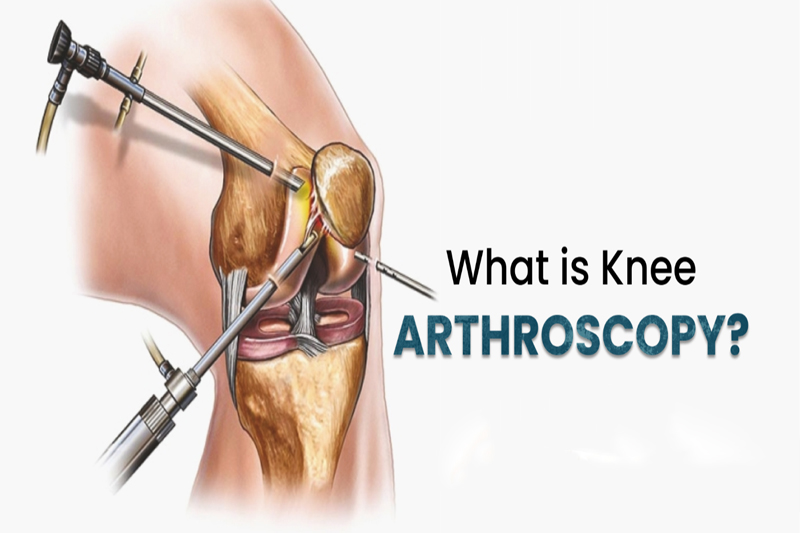 Knee Arthroscopy Explain in Detail's