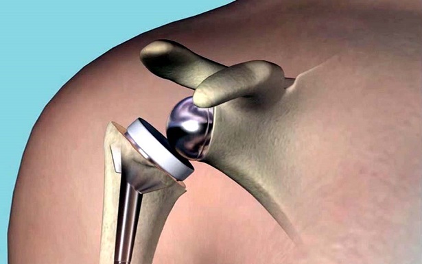 Reverse Shoulder Arthroplasty