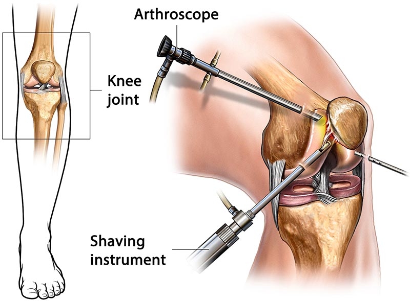 Arthroscopic Knee Surgery