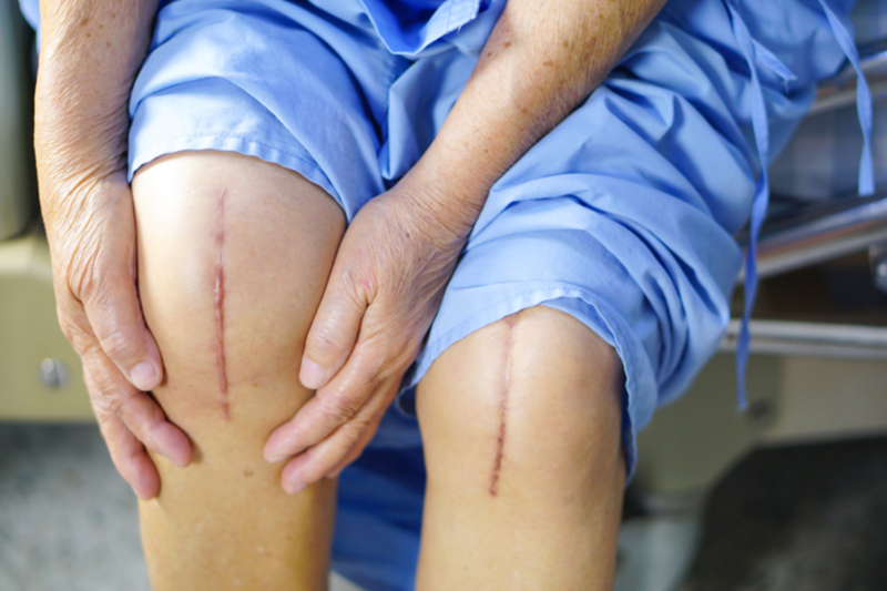 Knee Replacement In Nagpur after surgery shows patient's knee is successfully replace