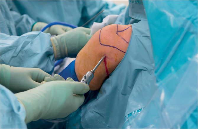 shoulder arthroscopy