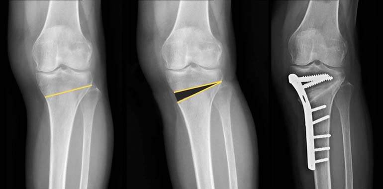 knee joint preservation