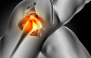 hip joint replacement