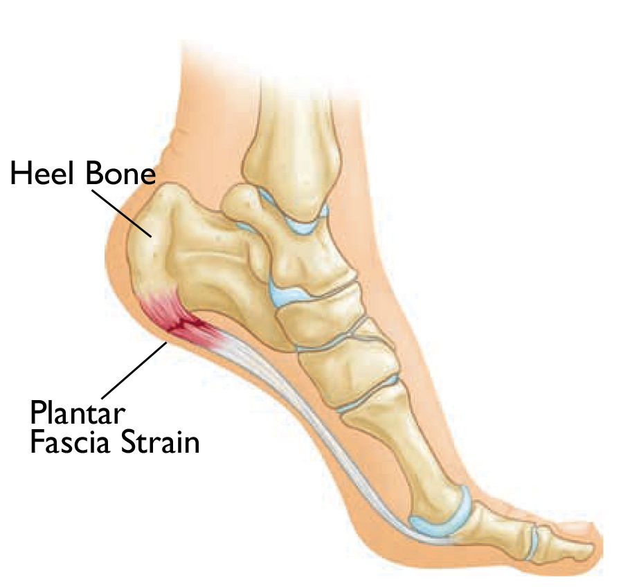 heel pain