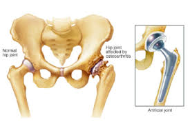 hip replacement