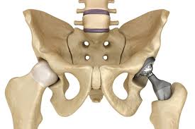 hip replacement