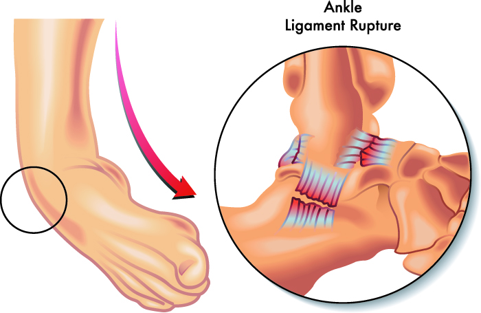 Ligament Surgeon