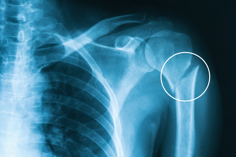 shoulder fracture