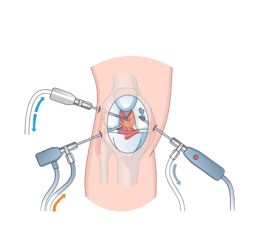 Arthroscopy