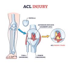 ACL Injury