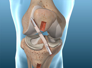 ACL Surgery With Internal Brace