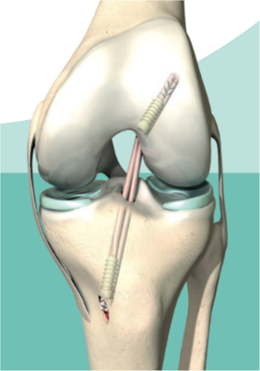 ACL Surgery With Internal Brace