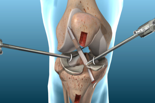 ACL Surgery With Internal Brace in Chhindwara