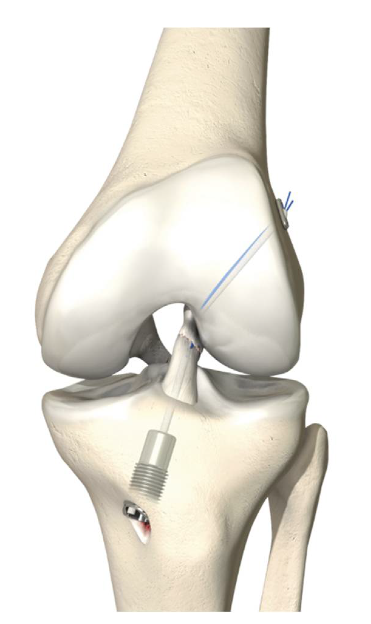 ACL Surgery With Internal Brace in betul