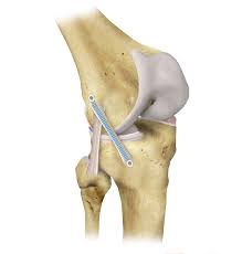 ACL Surgery With Internal Brace