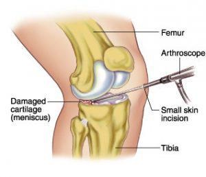 meniscus knee surgery