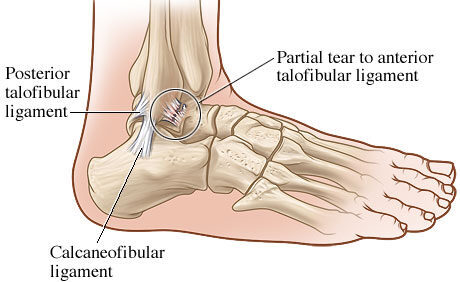 Ligament Injury