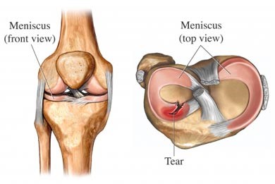 Meniscus Tear