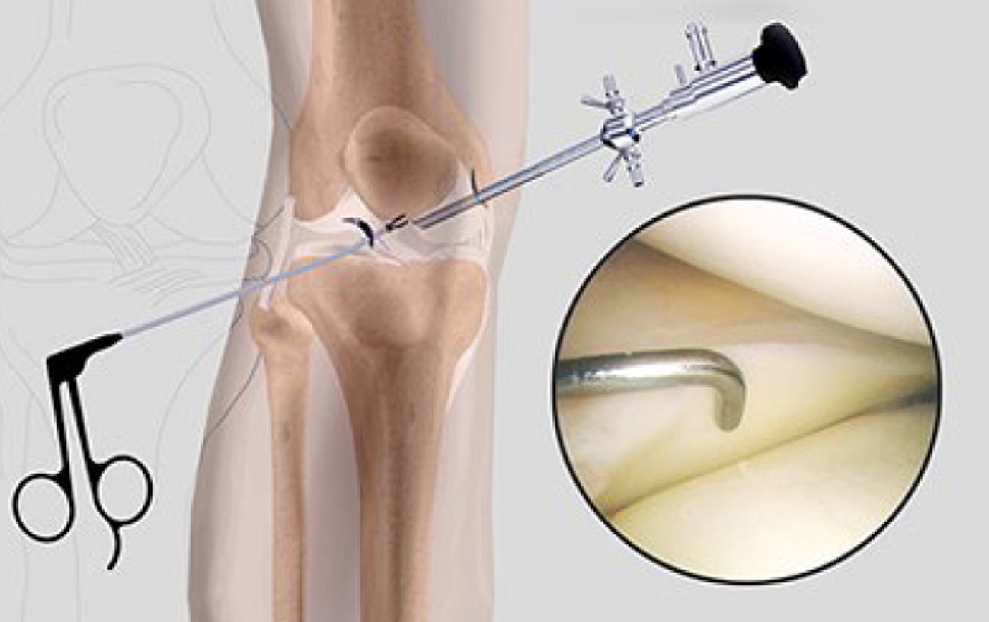 Meniscus Tear Knee Arthroscopy