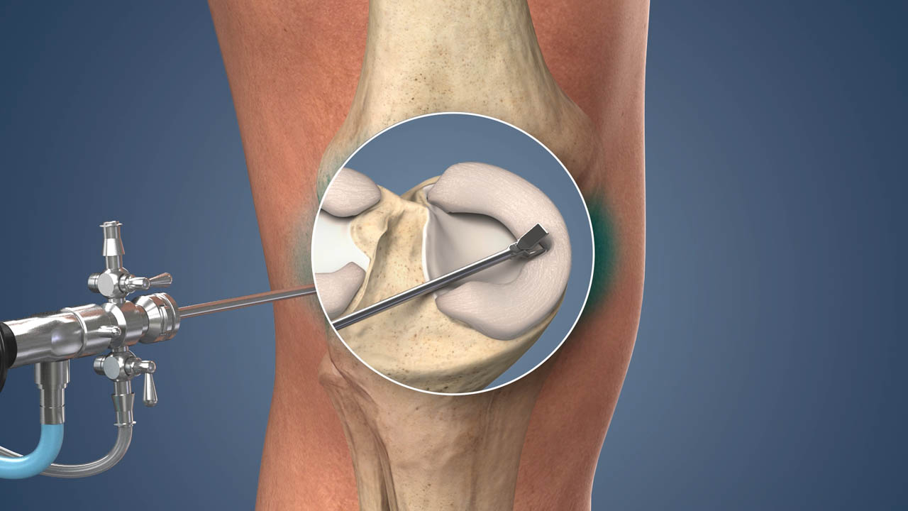 Meniscus Tear Knee Arthroscopy