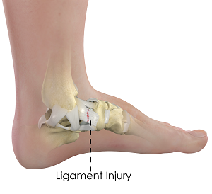 Ligament Injury